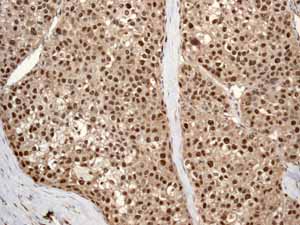 ab92554 showing positive staining in Hepatocellular carcinoma tissue.