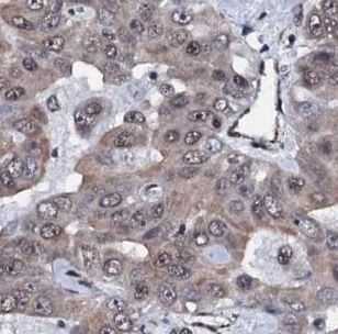 Immunohistochemical staining of Human liver cancer tissue labeling CWC15 using ab188345 at 1/500 dilution.