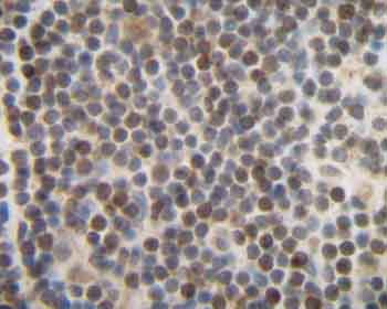 ab46010 staining Cxcl14/BRAK in human breast invasive, ductal carcinoma tissue by Immunohistochemistry (Formalin/PFA fixed paraffin-embedded sections). Tissue underwent heat mediated antigen retrieval in sodium citrate buffer (pH 6.0). The primary antibody was used at 0.25 ug/ml and incubated with sample at 4°C overnight. A HRP-labeled polymer detection system was used with a DAB chromogen.