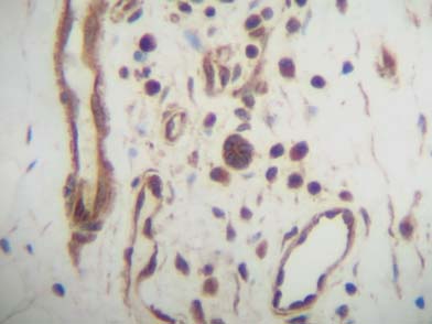 ab46010 staining Cxcl14/BRAK in human breast invasive, ductal carcinoma tissue by Immunohistochemistry (Formalin/PFA fixed paraffin-embedded sections). Tissue underwent heat mediated antigen retrieval in sodium citrate buffer (pH 6.0). The primary antibody was used at 0.25 ug/ml and incubated with sample at 4°C overnight. A HRP-labeled polymer detection system was used with a DAB chromogen.