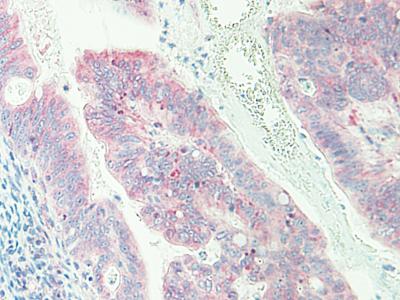 Immunohistochemical analysis of formalin-fixed paraffin-embedded Human colorectal adenocarcinoma tissue, labeling CXCL16 using 0.5 μg/ml of ab175341. An HRP-labeled polymer detection system was used with a DAB chromogen.