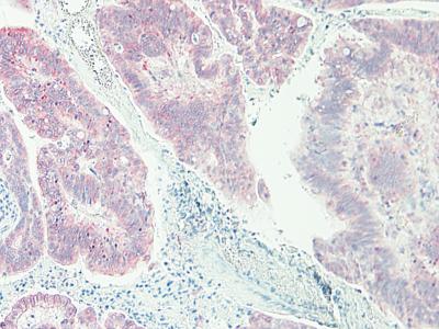 Immunohistochemical analysis of formalin-fixed paraffin-embedded Human colorectal adenocarcinoma tissue, labeling CXCL16 using 0.5 μg/ml of ab175341. An HRP-labeled polymer detection system was used with a DAB chromogen.