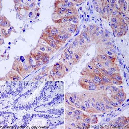 Immunohistochemical analysis of paraffin-embedded Human colonic carcinoma tissue labeling CXCL5 + CXCL6 with ab198505 at 1/100 dilution followed by Goat Anti-Rabbit IgG H&L (HRP) (ab97051) at 1/500 dilution and counter-stained with Hematoxylin. Inset image: negative control obtained using PBS instead of ab198505 and secondary antibody only.Note: Cytoplasm staining on human colonic carcinoma tissue was observed.
