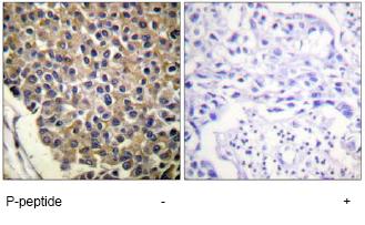 1/50-1/100 ab61100 staining phosphorilated CXCR2 on human breast carcinoma tissue, in the presence or absence of the immunizing phospopeptide.
