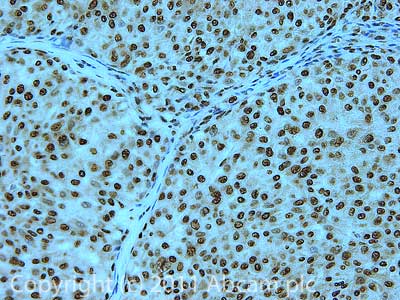 IHC image of ab53699 staining in Human Breast cancer formalin fixed paraffin embedded tissue section, performed on a Leica BondTM system using the standard protocol F. The section was pre-treated using heat mediated antigen retrieval with sodium citrate buffer (pH6, epitope retrieval solution 1) for 20 mins. The section was then incubated with ab53699, 1µg/ml, for 15 mins at room temperature and detected using an HRP conjugated compact polymer system. DAB was used as the chromogen. The section was then counterstained with haematoxylin and mounted with DPX.For other IHC staining systems (automated and non-automated) customers should optimize variable parameters such as antigen retrieval conditions, primary antibody concentration and antibody incubation times.