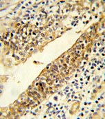 Immunohistochemistry (Formalin/PFA-fixed paraffin-embedded sections) analysis of human prostate carcinoma tissue labelling CY51A1 wit ab135723. A peroxidase-conjugated anti-rabbit IgG was used as the secondary antibody, followed by DAB staining.
