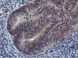 ab119803 at 1/150 dilution staining Cystatin SA in Paraffin-embedded Human Endometrium adenocarcinoma tissue by Immunohistochemistry.