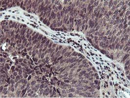 ab119803 at 1/150 dilution staining Cystatin SA in Paraffin-embedded Human Bladder carcinoma tissue by Immunohistochemistry.