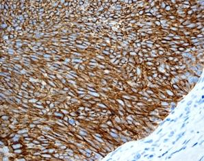 Immunohistochemical analysis of Cytokeratin 13 in formalin fixed, paraffin embedded Human transitional cell carcinoma of urinary bladder tissue stainied with ab133340 at a 1/100 dilution.