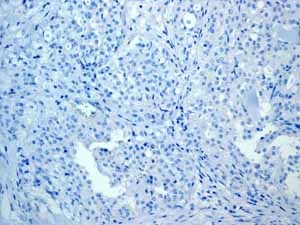 Immunohistochemical analysis of paraffin embedded Human Breast carcinoma tissue using ab133340 showing -ve staining.