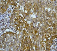 Immunohistochemical analysis of Cytokeratin 16 in paraffin embedded human squamous cervical carcinoma tissue using ab76416 at a 1/100 dilution.