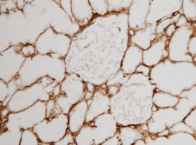 Immunoperoxidase staining of unfixed frozen tissue sections with ab6308. Picture of human kidney cortex showing two glomeruli and surrounding tubulointerstitium.
