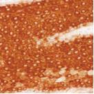 ab25774, at a 1/50 dilution, staining human keratin 16 in human squamous cell carcinoma by Immunohistochemistry, Formalin fixed Paraffin embedded tissue.