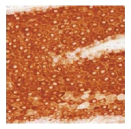 ab25820, undiluted staining human cytokeratin 16 in squamous cell carcinoma by Immunohistochemistry, Formalin fixed Paraffin embedded tissue.