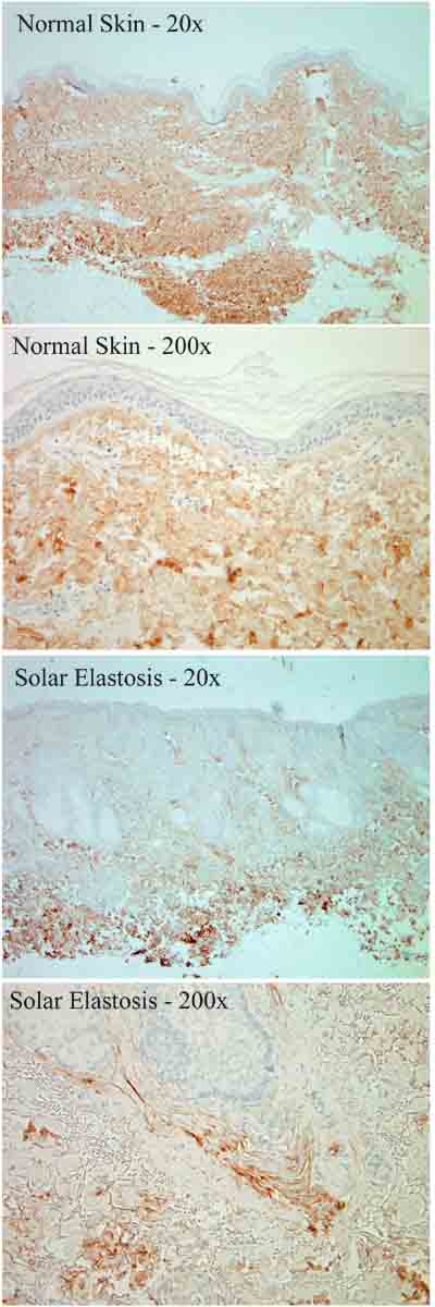 Formalin fixed paraffin embedded human normal Skin and basal cell carcinoma/solar elastos stained with ab6308 at 1/800 for 30min.