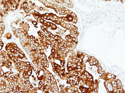 Immunohistochemical analysis of paraffin embedded N87 xenograft labelling Cytokeratin 17 using ab137846 at a 1/100 dilution.