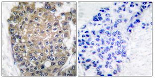 Immunohistochemical analysis of paraffin-embedded human breast carcinoma tissue labeling Cytokeratin 17 with ab195725 at 1/50 dilution. The image on the right shows the negative control using PBS and Rabbit IgG Isotype Control.