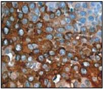 Immunohistochemical staining of paraffin embedded human cervical carcinoma tissue using ab51599 (1/100). Goat anti-rabbit HRP (1/2000) used for secondary staining.Immunohistochemical staining of paraffin embedded human cervical carcinoma tissue using ab51599 (1/100). Goat anti-rabbit HRP (1/2000) used for secondary staining.