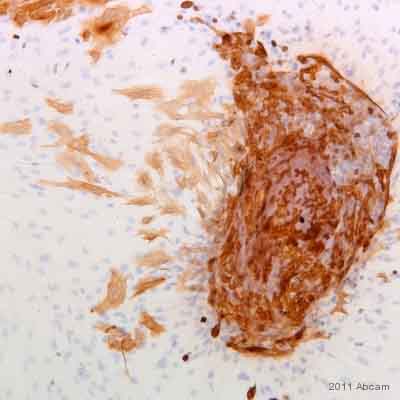 ab18586 staining Cytokeratin 6 in breast organoids derived from normal human breast tissue by Immunocytochemistry.Cells were fixed in methanol and blocked using 10% serum for 5 minutes at 25°C. Samples were then incubated with ab18586 at a 1/25 for 1 hour at 25°C. The secondary used was an undiluted HRP conjugated goat polyclonal.See Abreview