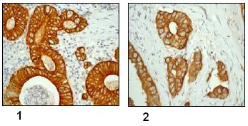ab76584, at a 1/100 dilution, staining Cytokeratin 8 in paraffin embedded human gastric adenocarcinoma (image 1) and human breast adenocarcinoma (image 2) tissues by Immunohistochemistry. 