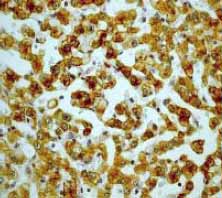 IHC-P analysis (with antigen retrieval) of liver carcinoma using anti-Phospho-Keratin 8 (ab32579) diluted 1/500.