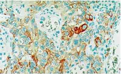 Formalin fixed paraffin embedded human lung carcinoma stained with Cytokeratin using ABC and AEC chromogen.