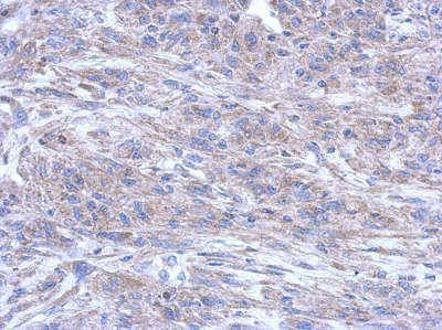 Immunohistochemical analysis of paraffin-embedded U373 xenograft tissue labeling Cytoplasmic dynein 1 light intermediate chain 1 with ab154251 at 1/500 dilution.