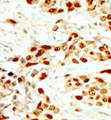 Immunohistochemistry (Formalin/PFA-fixed paraffin-embedded sections) analysis of human breast carcinoma tissue labelling DAP Kinase 2 with ab37995. A peroxidase-conjugated anti-rabbit IgG was used as the secondary antibody, followed by DAB staining.