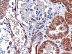 ab40821 at 3µg/ml staining DARC in human kidney tissue by Immunohistochemistry (Formalin/PFA-fixed paraffin-embedded sections). Microwaved antigen retrieval using citrate buffer pH 6 was performed, HRP-staining.This antobody stains epithelial cells of renal tubules and endothelial cells of vessels. The granular staining is compatible with the endoplasmic reticulum association of the protein. This antibody has also been successfully used on human lung tissue showing endothelial staining.