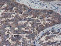 ab128111, at 1/150 dilution, staining COMMD1/MURR1 in paraffin-embedded Human ovary adenocarcinoma tissue by Immunohistochemistry.