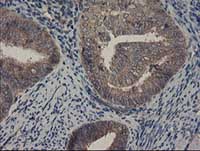 ab128111, at 1/150 dilution, staining COMMD1/MURR1 in paraffin-embedded Human endometrium adenocarcinoma tissue by Immunohistochemistry.
