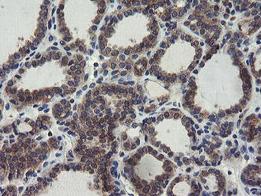 Immunohistochemical analysis of paraffin embedded Human thyroid carcinoma tissue labelling COMMD1/MURR1 with ab131597 at a 1/150 dilution.