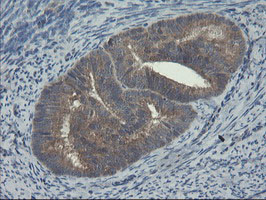Immunohistochemical analysis of paraffin embedded Human endometrium adenocarcinoma tissue labelling COMMD1/MURR1 with ab131597 at a 1/150 dilution.