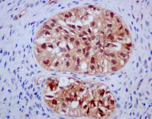 Immunohistochemical analysis of paraffin embedded Human ovarian carcinoma tissue labeling DDAH1 with ab180599 at a 1/50 dilution. Prediluted HRP Polymer for Rabbit IgG secondary used. Counterstained with Hematoxylin.