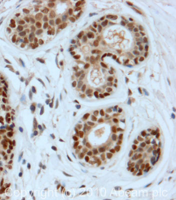 IHC image of DDB2 staining in Human Breast Carcinoma formalin fixed paraffin embedded tissue section, performed on a Leica BondTM system using the standard protocol F. The section was pre-treated using heat mediated antigen retrieval with sodium citrate buffer (pH6, epitope retrieval solution 1) for 20 mins. The section was then incubated with ab77765, 5µg/ml, for 15 mins at room temperature and detected using an HRP conjugated compact polymer system. DAB was used as the chromogen. The section was then counterstained with haematoxylin and mounted with DPX.
