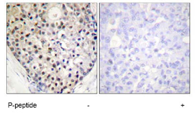 Immunohistochemistry analysis of paraffin-embedded human breast carcinoma tissue using ab63392 at 1:50 dilution.Left image untreated.Right image treated with phospho peptide.