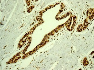 Immunohistochemical analysis of paraffin embedded Human breast tissue labeling DDX17 with ab180190 at 1/100.