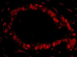 Formalin-fixed, paraffin-embedded section of Human ovarian carcinoma. Antibody: ab113259 used at a dilution of 1/100. Detection: red-fluorescent goat anti-rabbit IgG-heavy and light chain cross-adsorbed antibody DyLight® 594 conjugated, used at a dilution of 1/100.