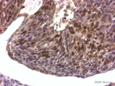 ab21696 staining human anal cancer tissue sections by IHC-P.  Sections were formaldehyde fixed and subjected to heat mediated antigen retreival in citrate buffer (pH 6) prior to blocking in a commercially available blocking agent for 20 minutes at 20°C.  The primary anibody was diluted 1/1000 and incubated with the sample for 40 minutes at 20°C.  A HRP-conjugated goat anti-rabbit antibody was used as the secondary.See Abreview