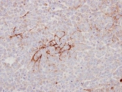 Immunohistochemical analysis of paraffin-embedded TOV112D xenograft labeling Decorin with ab151988 at 1/100 dilution.