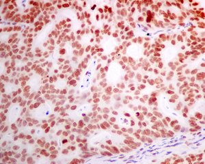 Immunohistochemical analysis of paraffin-embedded Human gastric carcinoma tissue labeling DEK with ab166624 at 1/250 dilution.