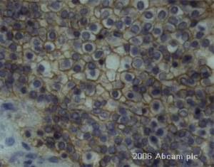ab14415 at a 1/10 dilution staining human urothelium (bladder cancer) by Immunohistochemistry (Formalin-fixed paraffin-embedded sections). The antibody was incubated with the tissue for 30 minutes following heat mediated antigen retrieval and paraformaldehyde fixation. See Abreview