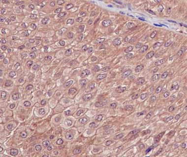 Immunohistochemical analysis of paraffin-embedded Human bladder transitional cell carcinoma tissue labeling Destrin with ab186754 at 1/100 dilution followed by prediluted HRP Polymer for Rabbit IgG. Counter stained with Hematoxylin.