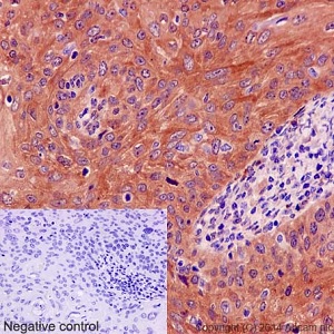 Immunohistochemical analysis of paraffin embedded human cervical carcinoma tissue sections labeling Destrin using ab192262 at a 1/100 dilution. A ready to use HRP Polymer for Rabbit IgG was used as the secondary. Hematoxylin counterstain.