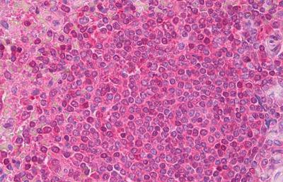 Immunohistochemical analysis of paraffin-embedded Human spleen (lymphocytes) tissue labelling Diazepam Binding Inhibitor with ab134277 at 1/400. Primary incubation was followed by biotinylated goat anti-rabbit IgG secondary antibody, alkaline phosphatase-streptavidin and chromogen.
