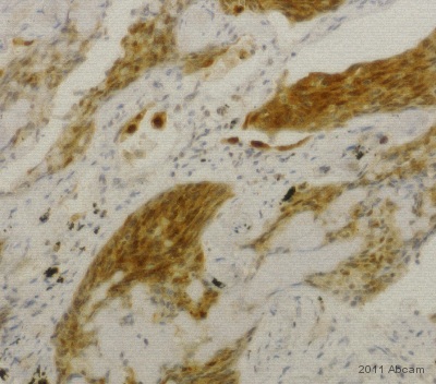 IHC-P image of Diazepam Binding Inhibitor antibody (ab16806) on Lung cancer sections. The sections were fixed in Paraformaldehyde and underwent heat mediated antigen retrieval using Novacastra (pH6). The sections were then blocked in 3% H2O2 solution for 10 minutes at 22°C.See Abreview