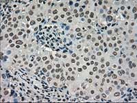 ab117984, at 1/50 dilution, staining Dihydrofolate reductase (DHFR) in paraffin-embedded Human breast adenocarcinoma tissue by Immunohistochemistry.
