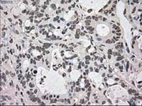 ab117984, at 1/50 dilution, staining Dihydrofolate reductase (DHFR) in paraffin-embedded Human colon adenocarcinoma tissue by Immunohistochemistry.