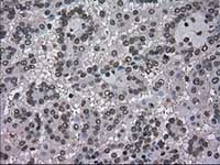 ab117984, at 1/50 dilution, staining Dihydrofolate reductase (DHFR) in paraffin-embedded Human kidney carcinoma tissue by Immunohistochemistry.