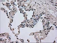 ab117984, at 1/50 dilution, staining Dihydrofolate reductase (DHFR) in paraffin-embedded Human lung carcinoma tissue by Immunohistochemistry.